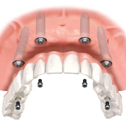 All on 4 Same Day Smile uses dental implants to stabilize your denture appliance.