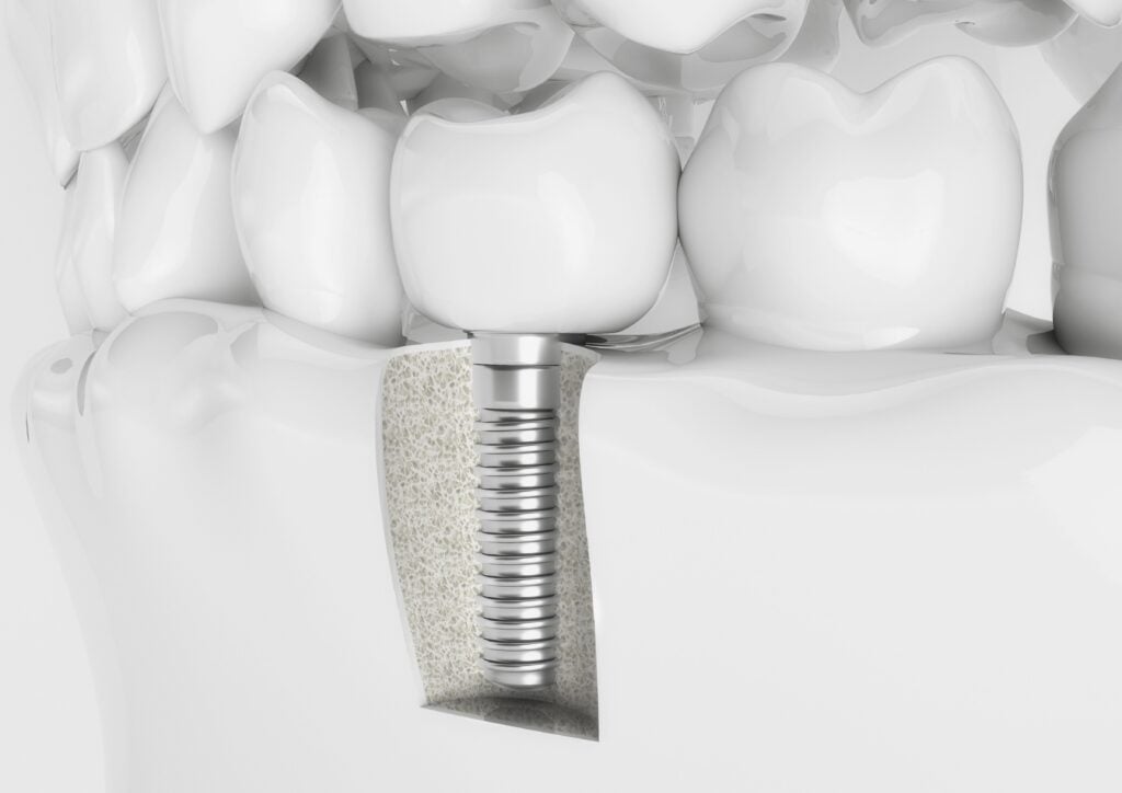 A dental implant is a perfect tooth replacement for missing teeth for patients in Harrisonburg, Waynesboro, Staunton, and Bridgewater.