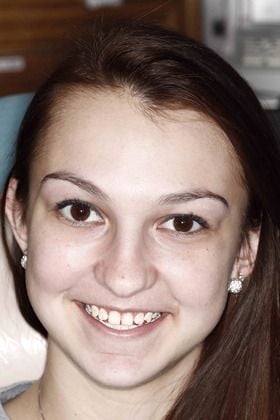 Patient before receiving porcelain dental veneers in Bridgewater.