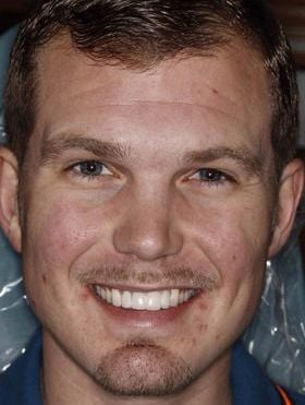 Patient showing off his new dental implants in Bridgewater.