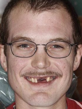 Patient with missing teeth before receiving dental implants in Bridgewater.