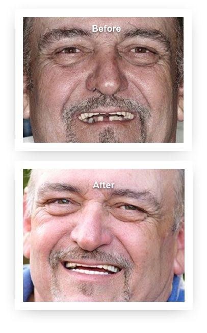 Patient before and after undergoing a cosmetic dentistry smile makeover in Staunton.