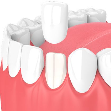 Porcelain dental veneers is one of the cosmetic dentistry procedures we offer.