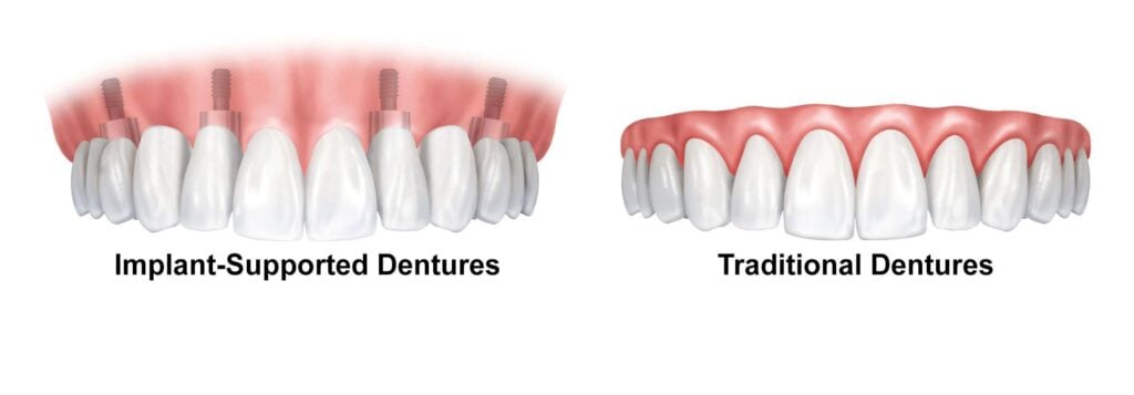 All on 4 implant supported permanent dentures are a great option for replacing missing teeth in Staunton.