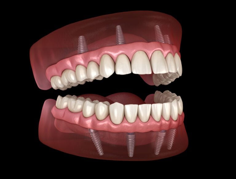 All on 4 same day dentures
