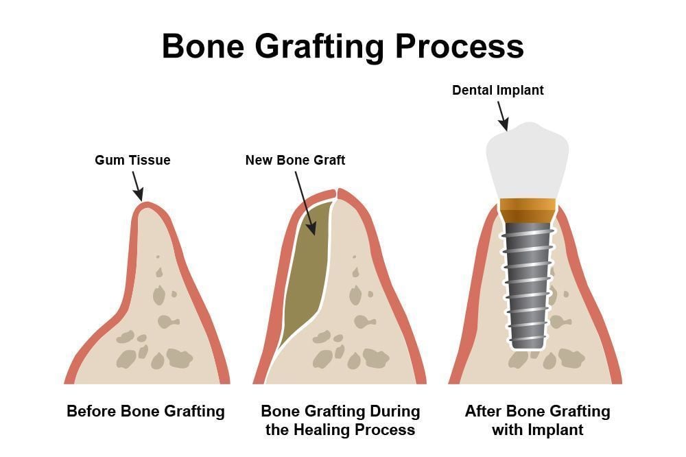 Sometimes bone grafting needs to be performed prior to the dental implant procedure.