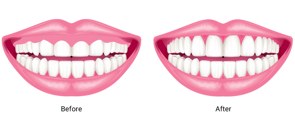 A gummy smile before and after gum contouring.