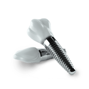 A screw retained implant crown is an extremely realistic tooth replacement option.