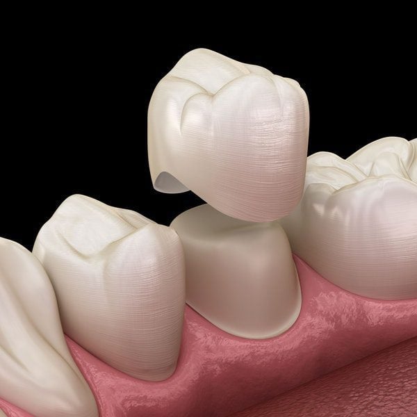 Close up photo of a traditional tooth crown.