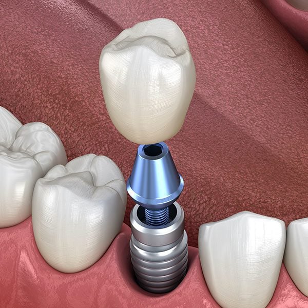 Single Implant with Crown
