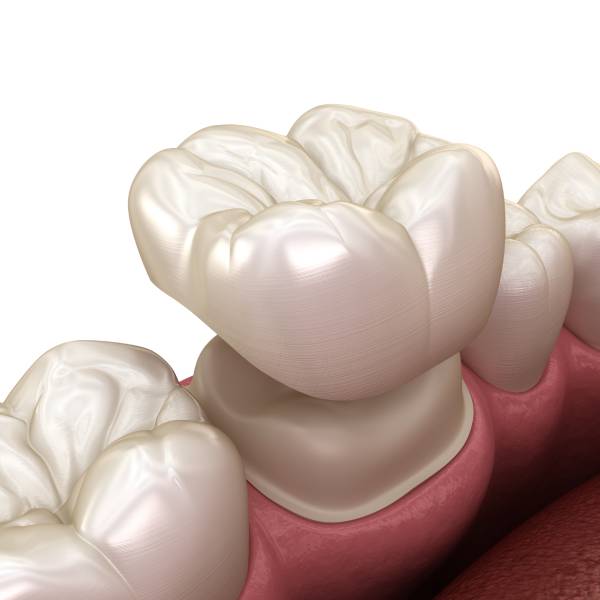 Dental crowns in Staunton and Bridgewater