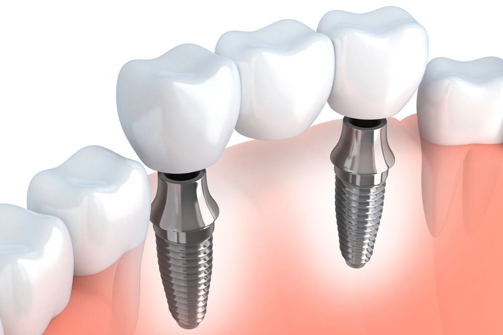 Implant supported bridges can fill the gap in missing teeth for patients in Staunton.