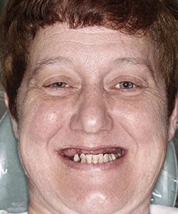 Patient before receiving traditional dentures in Staunton.