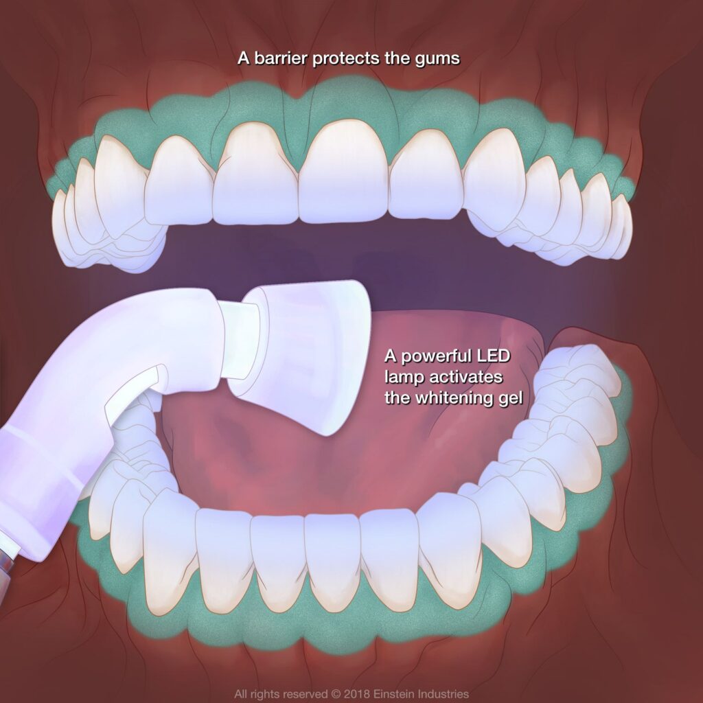 Diagram explaining how professional teeth whitening whitens teeth.