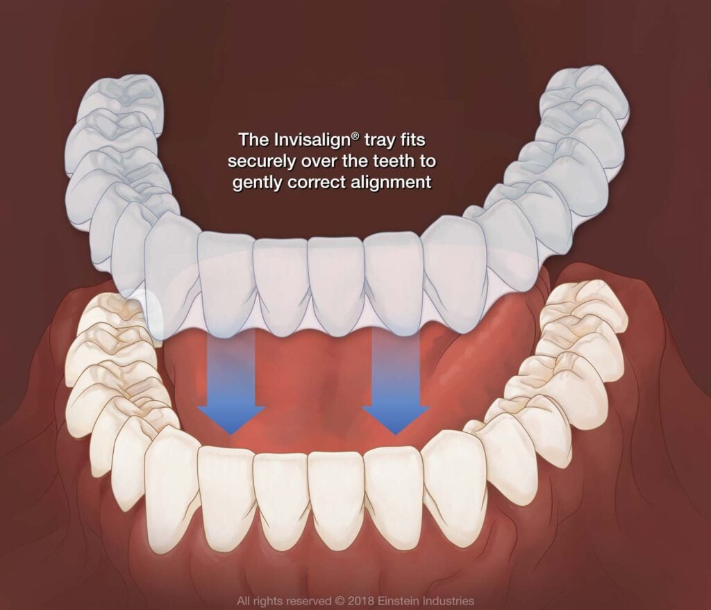 Diagram showing how Invisalign clear braces straighten teeth for patients near Harrisonburg and Waynesboro.
