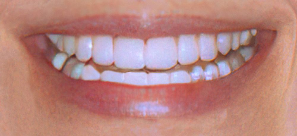 Patient from Harrisonburg showing off her brand new dental veneers.
