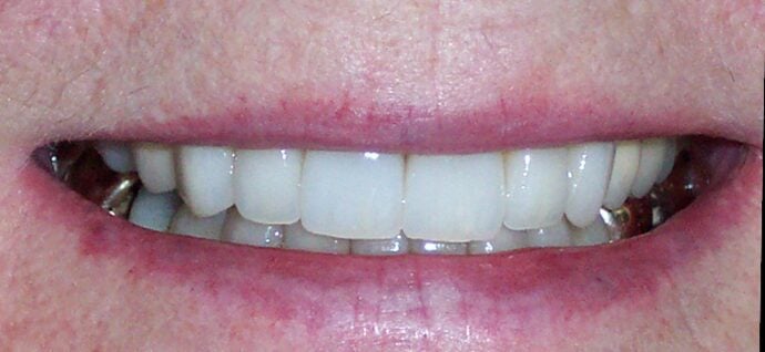 Patient after undergoing professional teeth whitening in Staunton.