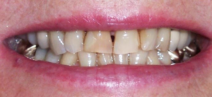 Patient with dark, yellowed teeth.
