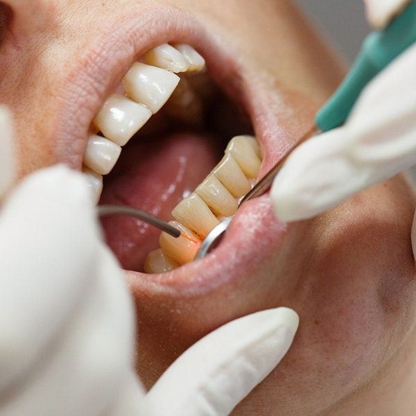 Soft tissue laser is one of the forms of gum disease in Staunton.
