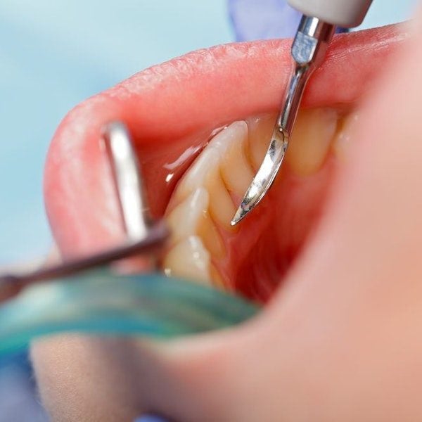 Scaling and root planing is one of the treatments for gum disease we offer in Bridgewater and Staunton.