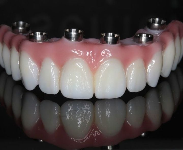 Implant bridges are a type of restorative dentistry procedure.