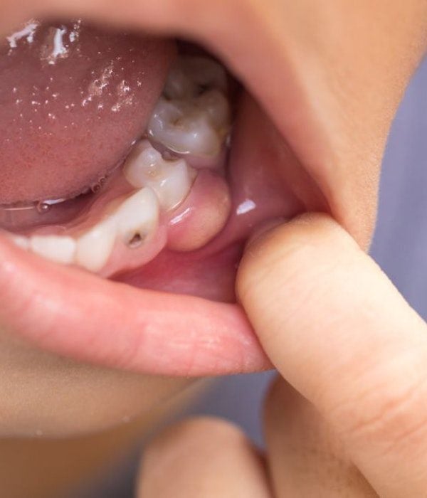 Close up photo of inflamed gums due to periodontal disease.
