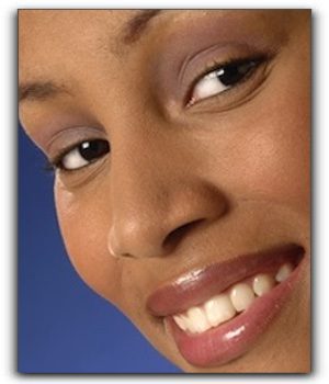 prepless veneers