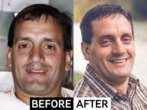 Manny Fisher, before and after cosmetic dentistry smile makeover