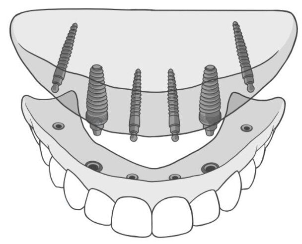 Stabili-Teeth Treatment