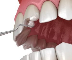 Broken tooth