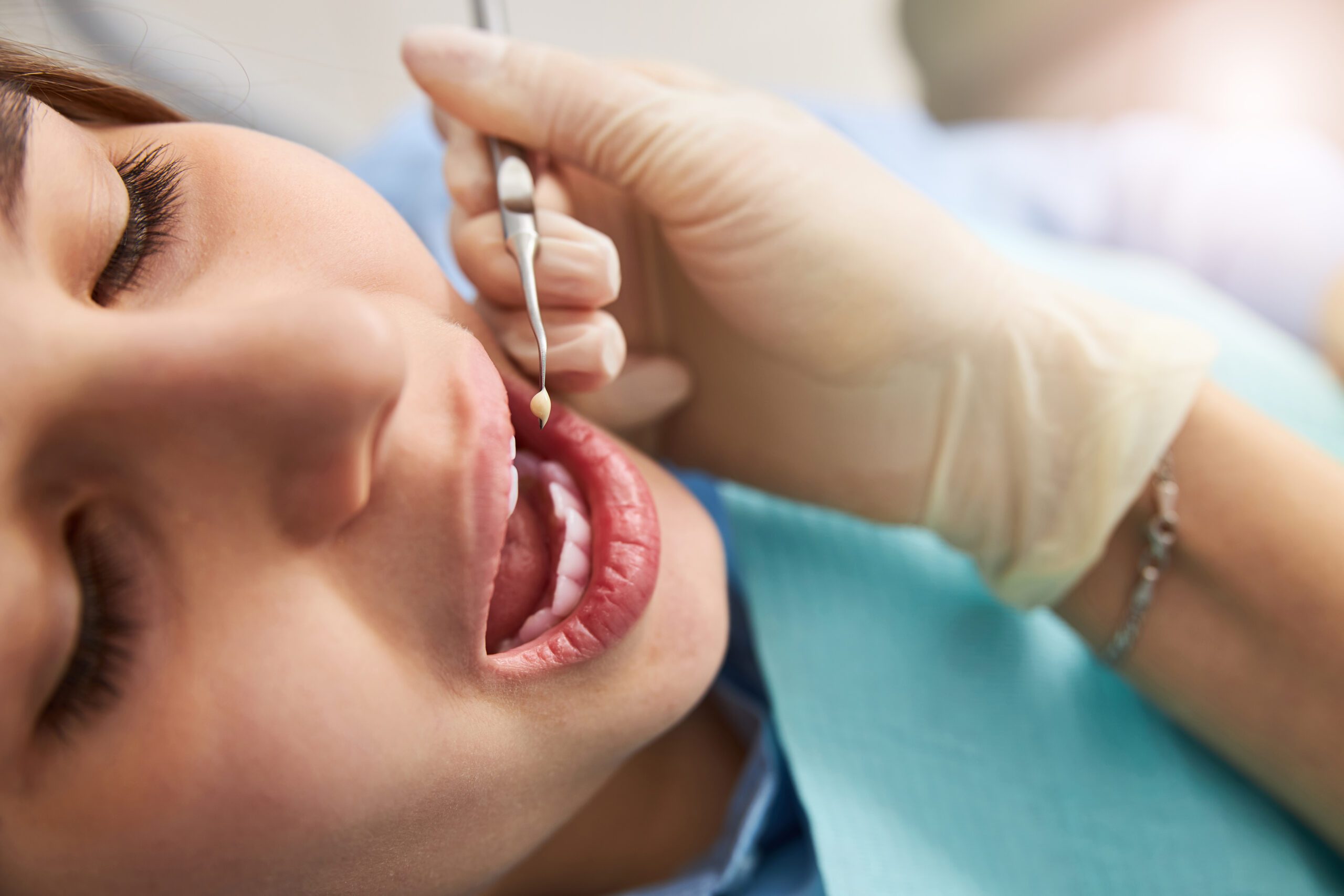 dentist examining a tooth, checking for tooth decay