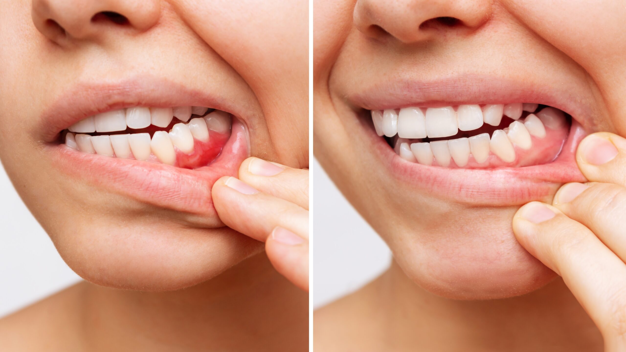 side by side closeup of the early signs of gum disease progression