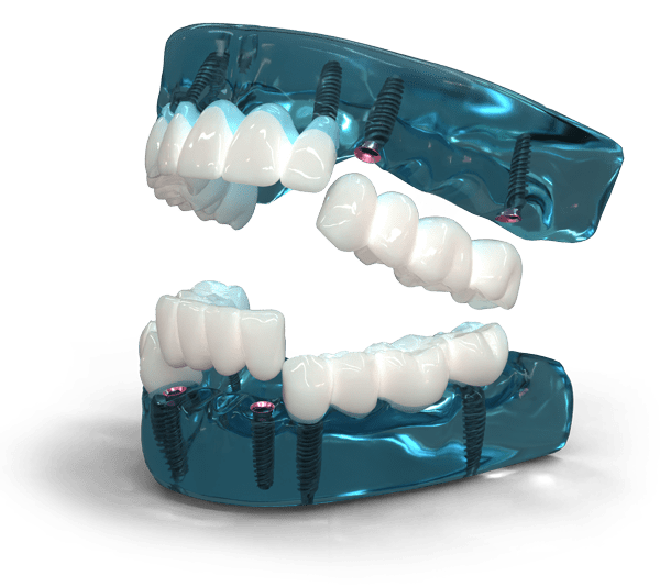 3 on 6 Dental Implants