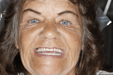 Cindy - After Stabili Teeth