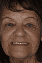 Cindy - Before Stabili Teeth